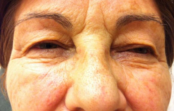 Szemhéj plasztika 1. páciens