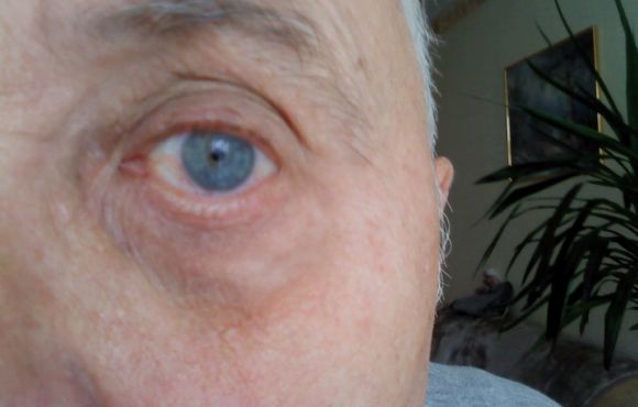 Szemhéjszéli elváltozás 5. páciens