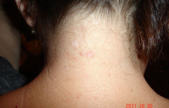 Anyajegyek és egyéb bőrelváltozások