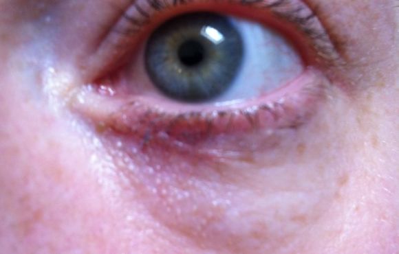 Daganat a szemhéjon 6. páciens