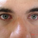 Kötőhártya ciszta