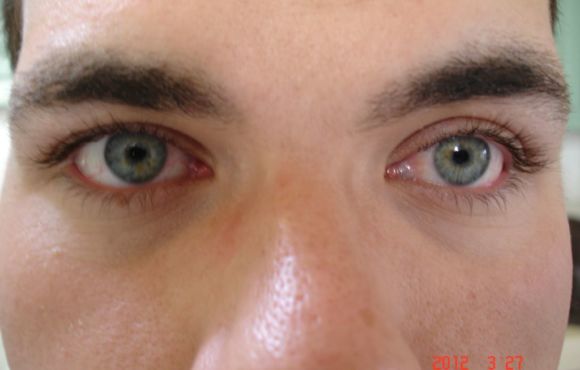 Kötőhártya ciszta és egyéb elváltozások