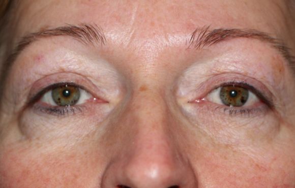 Szemhéj plasztika 2. páciens