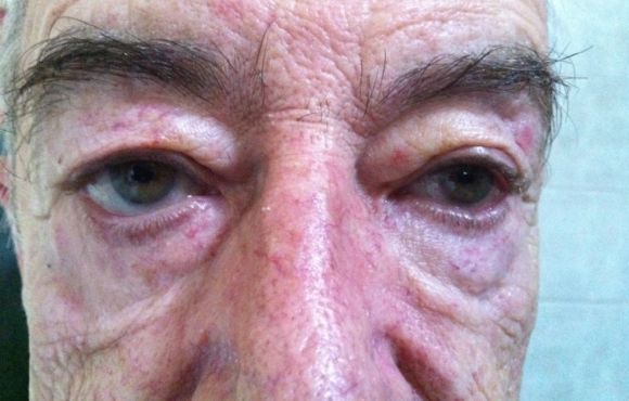 Szemhéj plasztika 4. páciens