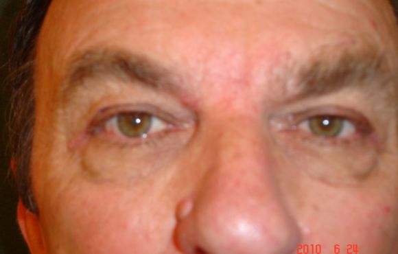 Szemhéj plasztika 3. páciens